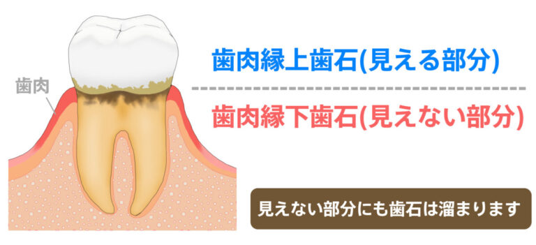 歯石は定期的に取った方がいい！その理由とケア方法