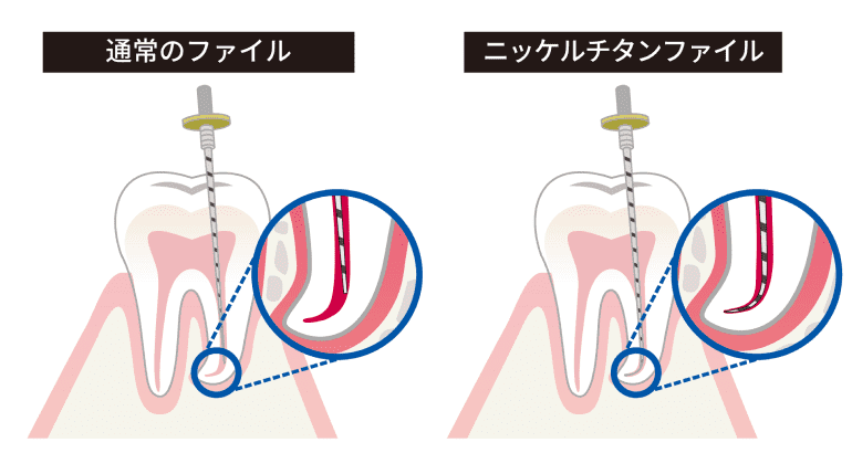 保険治療のメリットは、治療費が安く、どこの歯科医院でも費用が変わらないことです。